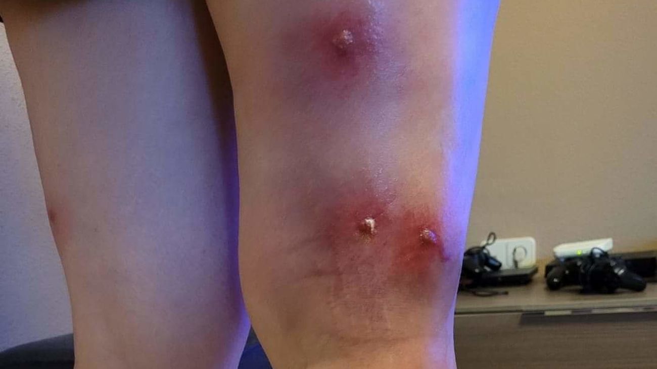 Mordiscos de mosca negra en las piernas de una persona