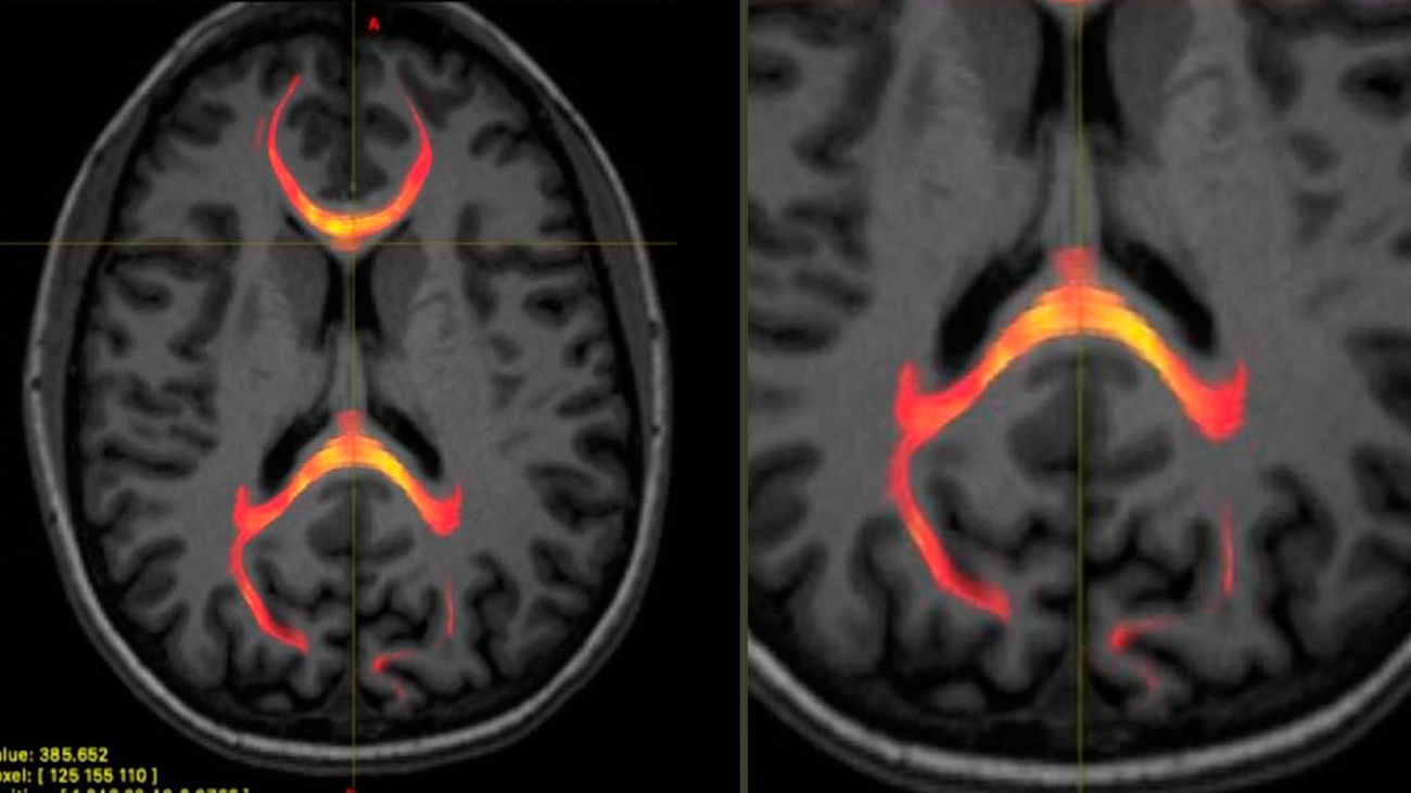 Imagen de RMN de un paciente con lesión cerebral
