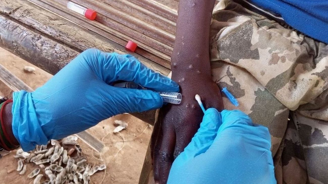 Un trabajador sanitario toma una muestra de una persona con mpox