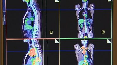 La FJD ensaya en humanos la primera vacuna contra el cáncer de pulmón