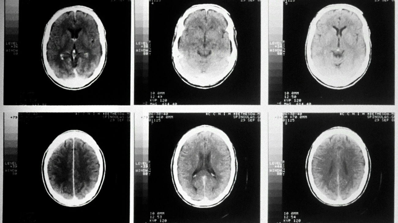 Resonancia magnética del cerebro