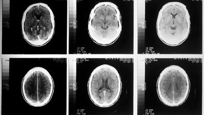 La UPM crea un sistema de IA que mejora el diagnóstico de tumores cerebrales